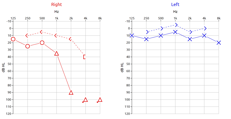 Tone audiometry