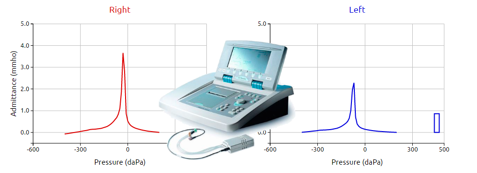 Tone audiometry